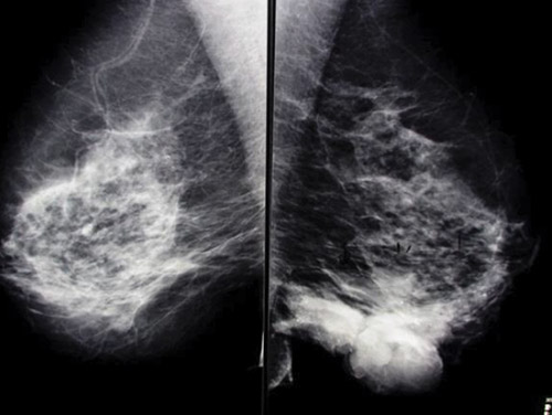 Figure 1 MLO film showing extent of disease in inferior part of left breast.